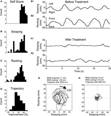 Treatment of the Mal de Debarquement Syndrome: A 1-Year Follow-up